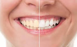 Polisseur Dentaire Électrique LED – Appareil de Blanchiment des Dents avec 12 Embouts Interchangeables